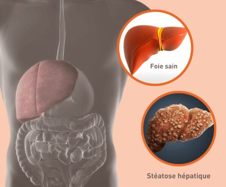 nafld